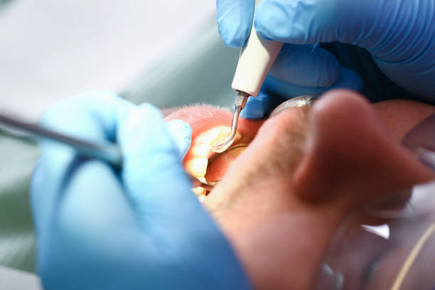 Best Emergency Treatment for Dental Infections or Abscesses in Ovilla, TX