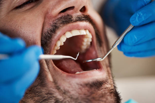 Best Emergency Wisdom Teeth Removal in Ovilla, TX